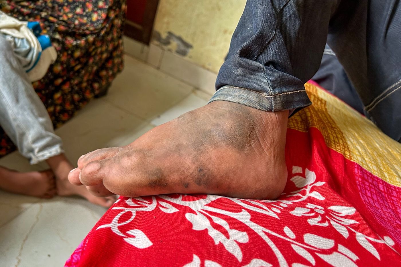 This is an image of Waseem's foot. 